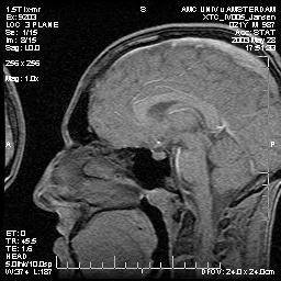 A sagittal MRI scan shows a cross-section of a human brain and skull.